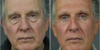 Man treated with Facial Fat Transfer - Before and After Upper/Lower Blepharoplasty with Fat Injections