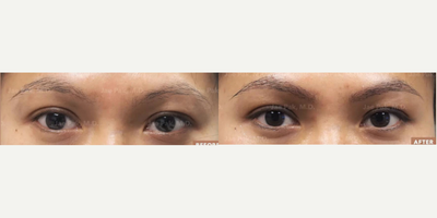 Woman treated with Eyebrow Transplant - Eyebrow Transplant