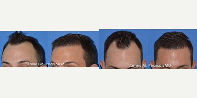 25-34 year old man treated with Hair Transplant - Hair Restoration using Follicular Unit Transfer. In this case, hair loss in the temporal areas was addressed with approximately 1500 grafts performed by Dr. James Pearson.