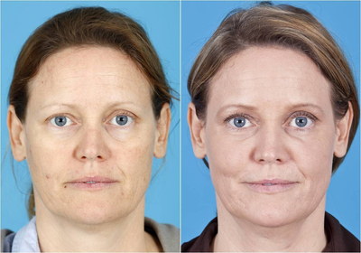 35 yo female with sunken eyes acne scar - CO2 fractional laser fillers juvederm sunken eyes acne scar Barrera