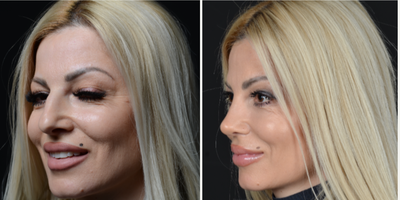 35-44 year old woman treated with Rhinoplasty - A transformation of our patient after an open ultrasonic rhinoplasty