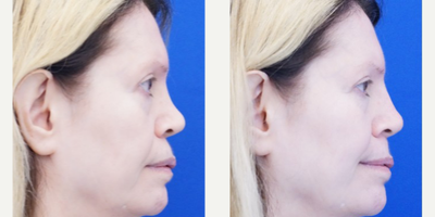 45-54 year old woman treated with Non Surgical Nose Job - Sunken nasal base and upper lip region are filled using Voluma injected deep onto the bone effectively acting as an implant known as plumping graft. Her entire nasal profile is more balanced. Nasal bridge is also slightly augmented.