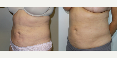 Woman treated with Exilis - Woman treated with Exilis