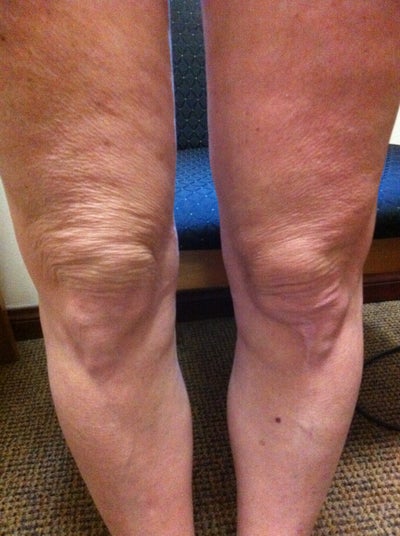 Laser Liposuction and Mixto CO2 laser of Knee photo from A. David