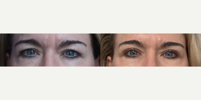 56 year old woman treated with Eyelid Surgery - 56 year old woman treated with upper eyelid under Local with Oral Sedation.