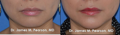 Chin Enhancement -
Chin Enhancement