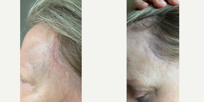 Patient treated with Scar Removal - Temporal Scar Removal - 55 to 64 year-old female patient is 1.5 years post-op from Scar Removal surgery. Her procedure was: Temporal Scar Removal.