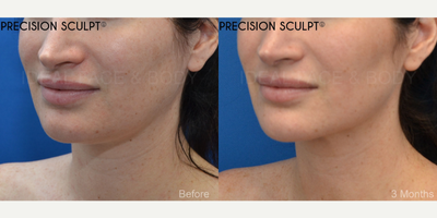 35 year old woman before and after advanced liposculpting of the chin, neck, and jawline. - This is a lovely female who wished for a more defined jawline, no double chin, and a snatched neck. We performed a specialized liposculpting procedure PRECISION SCULPT. This advanced surgery is performed under complete local anesthesia with the option of comfortable relaxation using oral medications. Tiny hidden incisions are used to evenly and smoothly remove all of the excess fat throughout the front of the neck from the chin to the angles of the jaw and down to the front of the lower neck. Laser and radiofrequency are delivered to the tissue to promote tightening. This procedure takes about 45 minutes. Patients typically return to work in a few days.