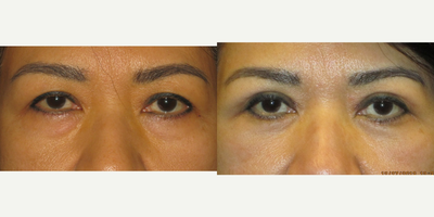 45-54 year old woman treated with Eyelid Surgery (upper and lower blepharoplasty) - This 50 year old woman of came to our Center wishing for rejuvenation of her eyes. She stated that she always looked tired and sad although she did not feel this way inside. During consultation and evaluation we decided together to perform both an upper and lower blepharoplasty to address the skin above her eyelids and the moderate fat bags below. The two procedures were performed safely under local anesthesia (with oral sedation with valium) in our office. She was able to return to work after 3 days and her sutures were removed after one week's time.