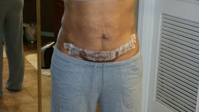 liposuction and tummy tuck recovery time