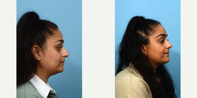 25-34 year old woman treated with Septoplasty - This 28-year-old patient felt very unhappy with the size and shape of her nose, as she had been self-conscious about it her entire life. The doctor performed a rhinoplasty to deemphasize the bump and make the tip smaller. 7 weeks post-op.