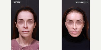55-64 year old woman treated with Facelift, Neck Lift, Facial Fat Transfer, Forehead Reduction, Brow Lift - Surgical Procedures:- Comprehensive Face and Neck Rejuvenation (Face & Neck Lift)- Philtral Shortening (Lip Lift)- Forehead Lift with Hairline Advancement- Secondary Lower Eyelid Surgery (Revision Lower Blepharoplasty)- Autologous Fat Grafting to the Nasolabial Folds