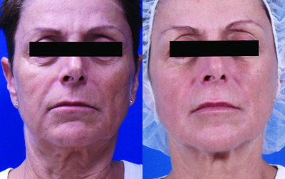 Venus Legacy - Before and After 10 Treatments.Photos provided courtesy of Venus Concept, performed by Gitit Zucker, MD.