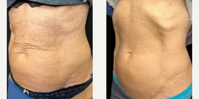 Woman treated with Sylfirm X - Woman treated with Sylfirm X