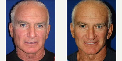Man treated with Brow Lift - Man treated with Brow Lift
