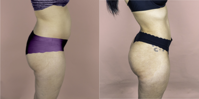 25-34 year old woman treated with Brazilian Butt Lift - Brazilian butt lift. Four months post-op.