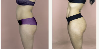 25-34 year old woman treated with Brazilian Butt Lift - Brazilian butt lift. Four months post-op.