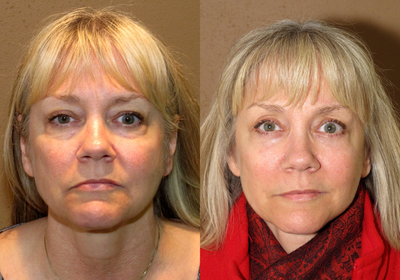 Upper face rejuvenation with endoscopic brow lift and blepharoplasties -
Early facial rejuvenation with a combination of the endoscopic brow lift, midface lift and blepharoplasties