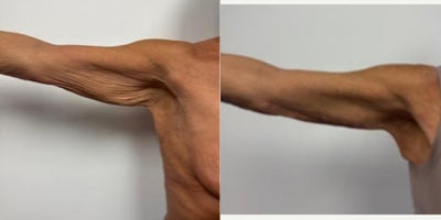 45-54 year old woman treated with Arm Lift - 6 months after an arm lift