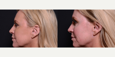 Woman treated with Microneedling - Woman treated with Microneedling