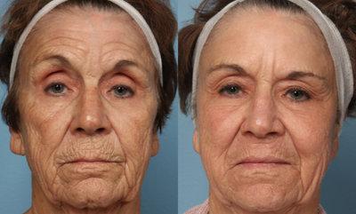 75 and up year old woman treated with Active FX - Patient received 1 Active FX treatment to her full face, in addition to Botox to her glabellar and crows feet region.
