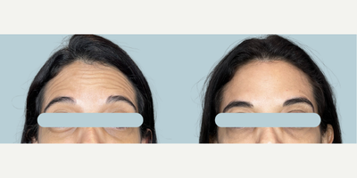 25-34 year old woman treated with Botox - When we do a botox application, we do it with a proprietary technique that allows us to give natural results without altering the facial expression. This technique is called multipoint microdosing and it involves applying small doses in multiple points and what is really important here is the form of application.