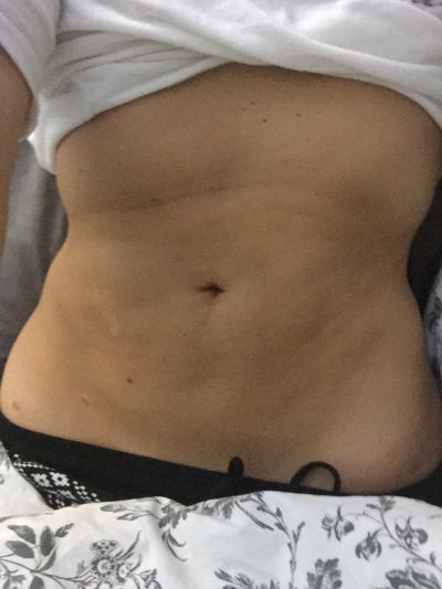 9 Weeks Post Traditional Liposuction By Board Certified Plastic Surgeon 