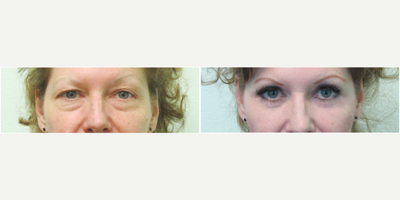 45-54 year old woman treated with Eye Bags Treatment and Upper Eyelid Lift - This active middle-aged woman presented with the concerns of constant eye bags under her eyelids. She stated that even with sufficient sleep at night, she would always notice puffiness that could not be concealed with makeup. She was bothered by the fact that her friends and family were always asking why she appeared so tired. During consultation exam, we noted significant protrusion of the fat underneath both eyelids. We also noted the excessive hooding of skin above her eyes as well. We decided to perform a total eye rejuvenation by selecting both the upper and lower eyelift (blepharoplasty) procedures.Under local anesthesia and mild oral sedation with xanax, both procedures were performed in under two hours in our Center.Her results demonstrate elimination of her fat bags below the eyes, as well as reduction of the overhang skin that was above her eyes previously. Makeup application was much easier for her. She felt that she appeared much more well rested while maintaining a natural look.