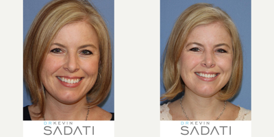 Orange County woman treated with Septorhinoplasty - Septorhinoplasty with Rhinoplasty Specialist Dr Kevin Sadati