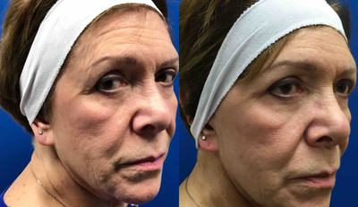 75 and up year old woman treated with Eyelid Surgery - Upper blepharoplasty procedure to help lift this woman's eyelids.