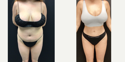 35-44 year old woman treated with Smart Lipo - Patient presented for liposuction to upper back, abdomen and flanks with a fat transfer to the buttocks.