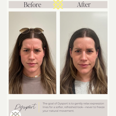 25-34 year old woman treated with Dysport - We helped this patient maintain a youthful and revitalized appearance but softening lines and reducing wrinkles using Dysport in the forehead and around the eyebrows.
