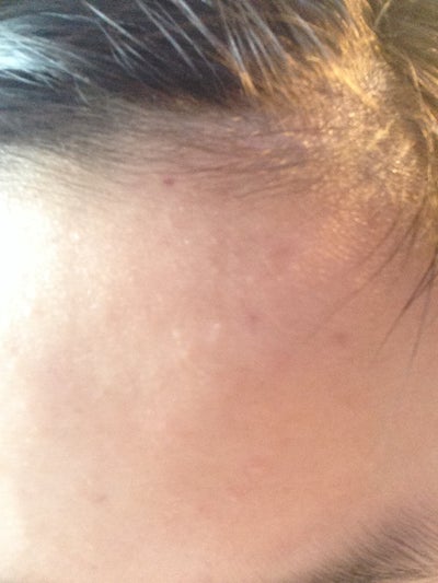 How to get rid of acne scars naturally? (photos) Doctor How to get rid of acne scars naturally? (photos) Doctor