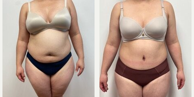 Woman treated with Liposuction - Woman treated with Liposuction.