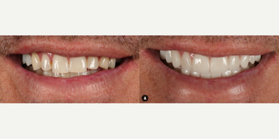 Man treated with Porcelain Veneers - Wear, decay, and missing teeth were restored to health with the use of porcelain restorations.