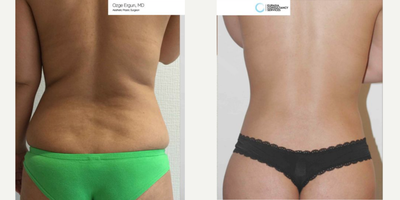 25-34 year old woman treated with Liposuction - Liposuction