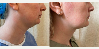 34 year old woman treated with Vaser Liposuction and Renuvion - Vaser liposuction of the jaw with Renuvion