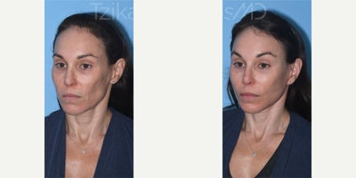 Woman treated with Brow Lift, Fractional Laser, Mini Facelift - Can you guess the secret behind my patients stunning transformation? Temporal Browlift: Lifts and revives those brows, giving the eyes a fresh, youthful look.eCO2 Fractional Laser: Smooths away those pesky lower eyelid wrinkles for a more radiant appearance.Lipografting (Nano/Micro): Have you ever wondered about the magic of nano and micro? Its simple - nano and micro refer to the size of fat graft particles used in the procedure. Theyre like tiny sculptors, adding just the right volume to cheeks and lips for a flawlessly natural contour.Mini Lift: Say hello to a tighter, more defined lower face and jawline!#minifacelift #lipografting #fractional_laser #browlift #tzikasmd #facialplasticsurgeon #plasticsurgerymiami #plasticsurgerydelray