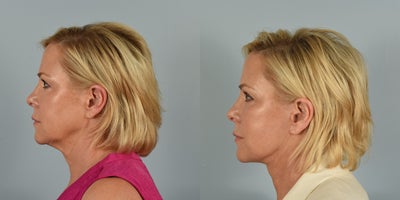 55-64 year old woman treated with Facelift, Neck Lift, Eyelid Surgery - 64 year old female who underwent Facelift, Neck Lift, upper and lower blepharoplasty, and temple lift 3 months ago.