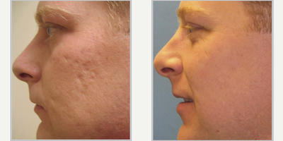 35-44 year old woman treated with ProFractional Laser - Profractional Laser + BB: