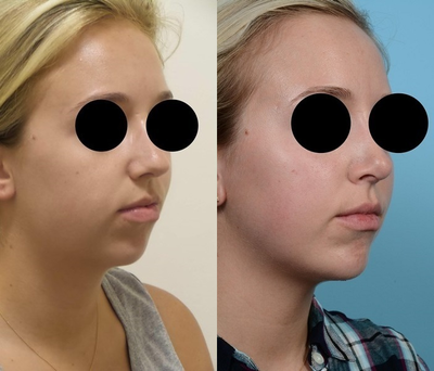 Woman treated with Chin Implant - Woman treated with Chin Implant