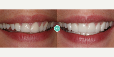 Woman treated with Porcelain Veneers - Woman treated with Porcelain Veneers