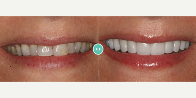 Woman treated with Porcelain Veneers - Woman treated with Porcelain Veneers