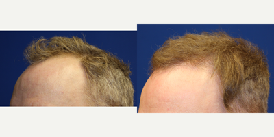 35-44 year old woman treated with Hair Transplant - 41 year old patient who underwent FUE hair transplant procedure. He received about 1,500 grafts mainly to the frontotemporal recession to achieve natural frontal hair line.