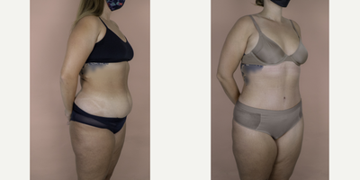 18-24 year old woman treated with Tummy Tuck - This amazing patient is shown 2-months post-op from Tummy tuck and flank liposuction. She was able to achieve a flatter stomach, smaller waist and an overall confidence-boosting result.