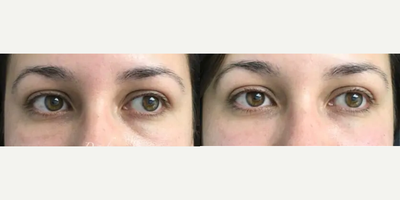 Woman treated with Belotero, Dermal Fillers, Hyaluronidase - Woman treated with Belotero, Dermal Fillers, Hyaluronidase