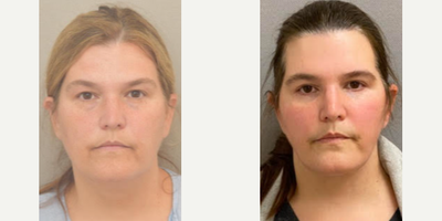 50 year old woman treated with SMAS Facelift as well as Neck Lift - 50 year old woman treated with SMAS Facelift as well as Neck Lift