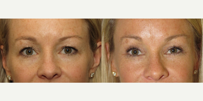45-54 year old woman treated with Brow Lift - 45 yo after endoscopic brow lift and upper blepharoplasty 6 months