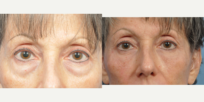 55-64 year old woman treated with Fat Transfer - Fat transfer to the lower eyelids will give a very natural result.