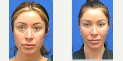 35-44 year old woman treated with Cheek Fillers - cheek filler placed by Y LIFT approach